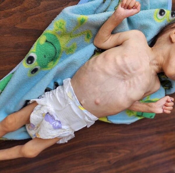 Gaza’s Famine