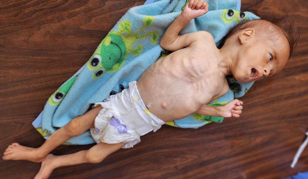 Gaza's Famine